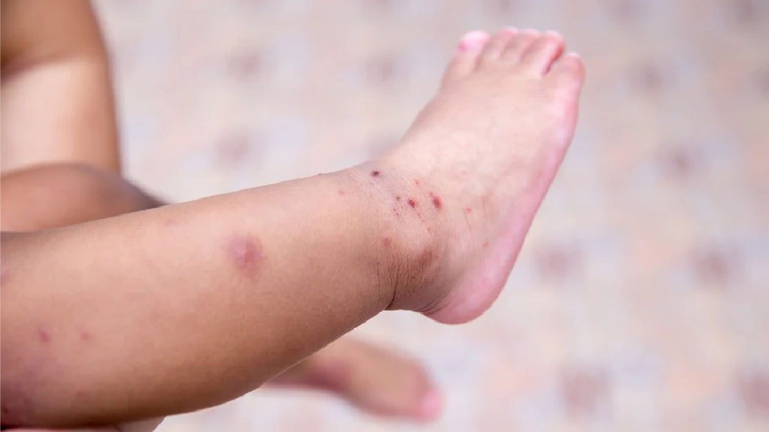 Breaking The Chain of Infection for Hand, Foot, and Mouth Disease